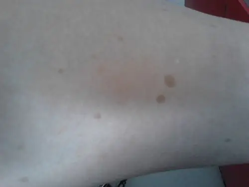 腿上出现斑点,已有2~3年,开始只有1~2个,后来越来越多.