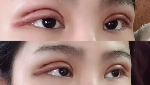 刚做完全切双眼皮图片