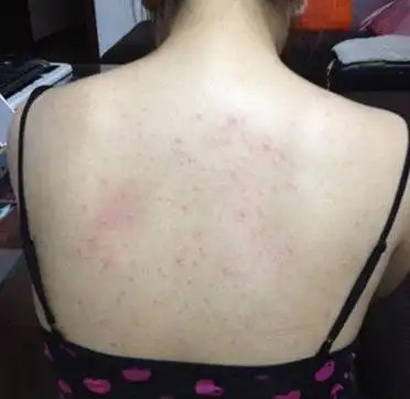 艾滋病后背疙瘩照片以及疙瘩特点症状