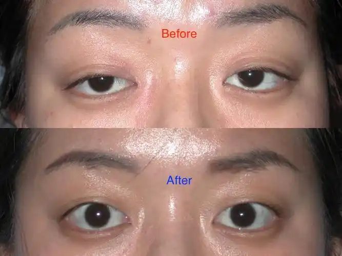 这是上睑下垂的人治疗前后的对比照片.