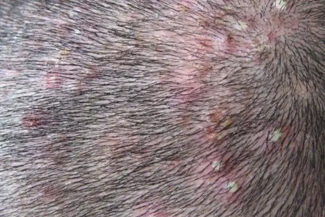 毛囊炎痘痘图片