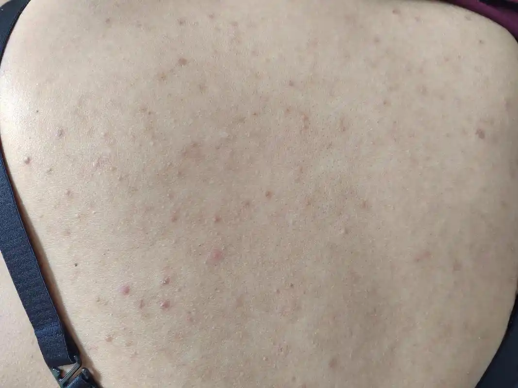 马拉色菌毛囊炎症状#解决皮肤问题专注皮肤美容##马拉色菌毛囊炎