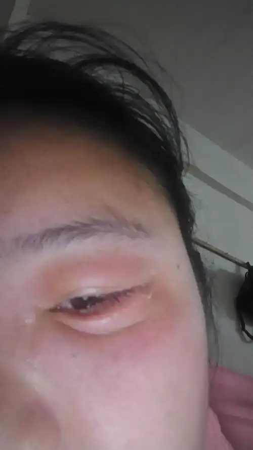 导致体内液体增多,导致眼睑浮肿肾炎在引起眼皮浮肿的同时,还会伴有