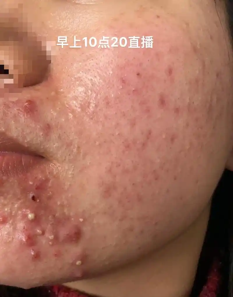 玫瑰痤疮 #激素脸 #问题性皮肤管理 #敏感肌 #痘痘肌  - 抖音