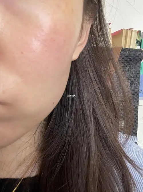 皮肤屏障受损_屏障受损_过敏_角质层_修复屏障_春天去哪玩_皮肤科