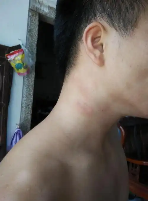 脖子上突然红了两处,是什么病吗?