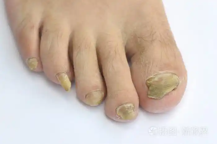 指甲上的真菌感染
