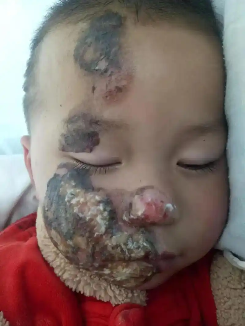 从你的脸烧烫伤到现在一年的时间,你的脸终于恢复好了,半年前脸 - 抖