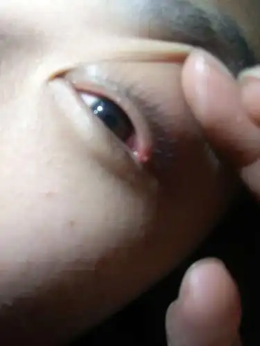 眼角长小疙瘩,还很痛,请问这是怎么回事