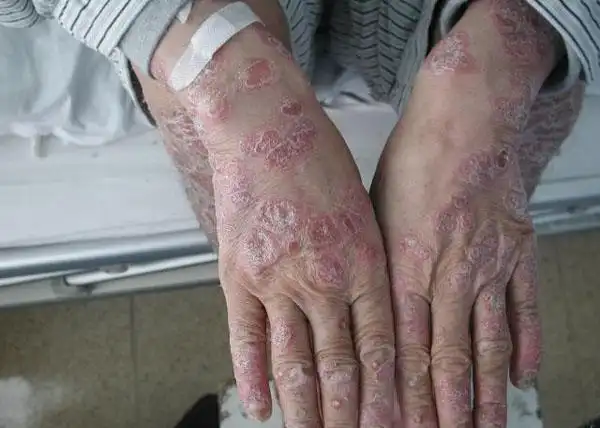 一名艾滋病人在感染hiv病毒后的几年,出现严重的银屑病样皮疹,患者经