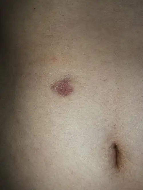 萎缩型隆突性皮肤纤维肉瘤1例