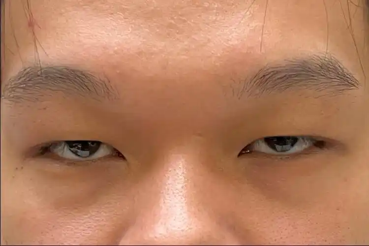 肿眼泡 肌无力 眼睛改变面相 尽显少年感!