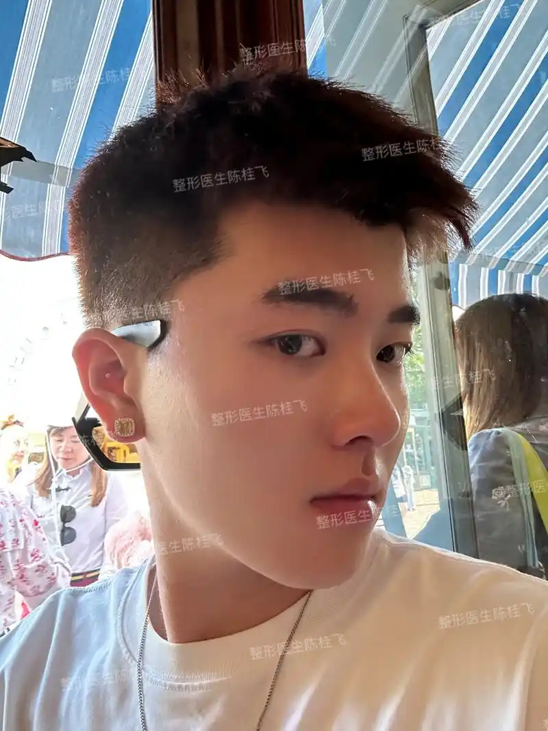 【男士肋骨鼻综合案例】 这位小帅哥来自湖南,术前主要是鼻梁山根低