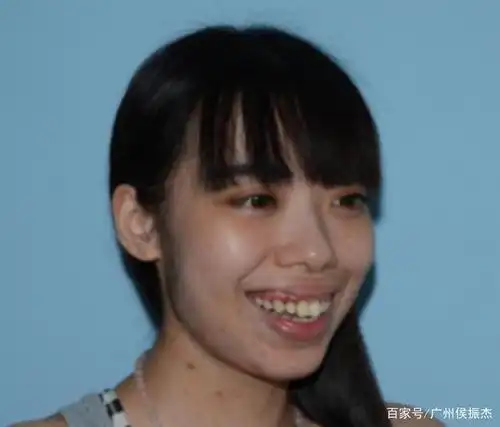 龅牙前凸矫正前后对比照