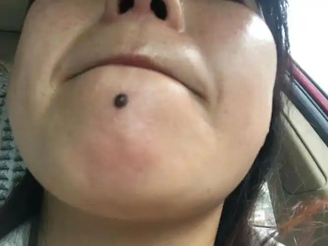 我今年30岁今年开始下巴的痣开始又痒又痛还长毛很黑怎么回事?