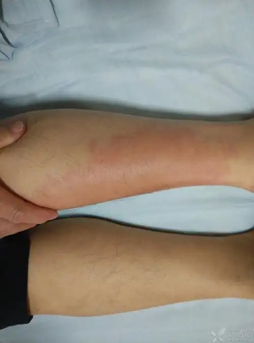 患者近5月来反复出现发热恶寒,左下肢红肿,皮温高,曾予头孢治疗,症状