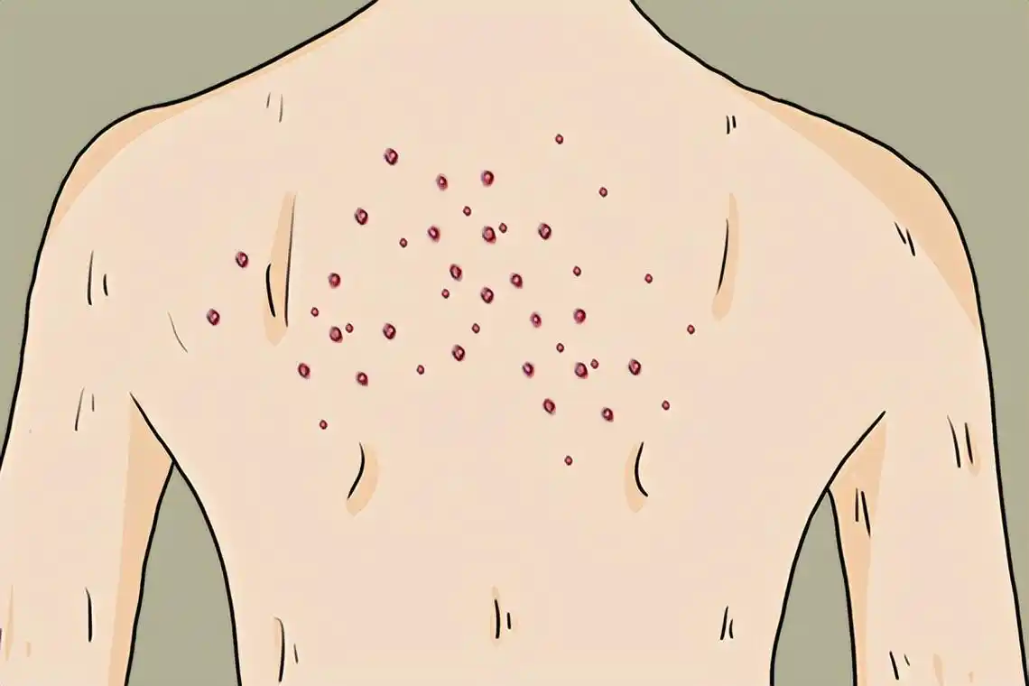 后背爱出油,还抠出"小米粒",想要光滑的皮肤,应该怎么做?