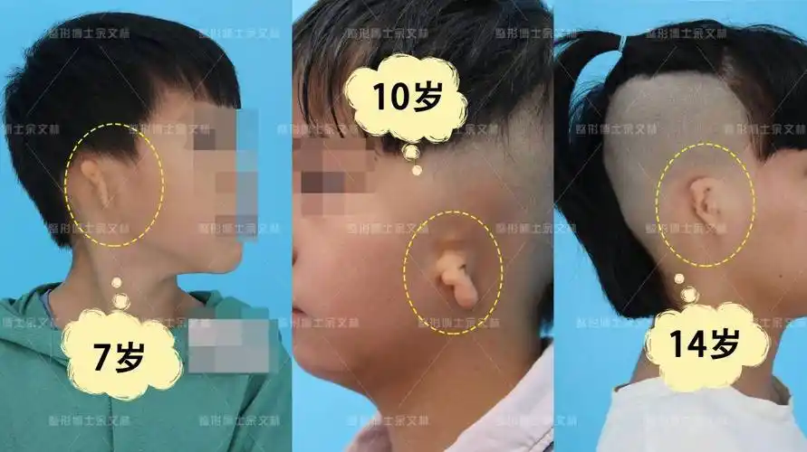 影响_耳轮_耳廓