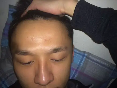 经常熬夜 发际线和鬓角往后移了两条街 有点脱发.
