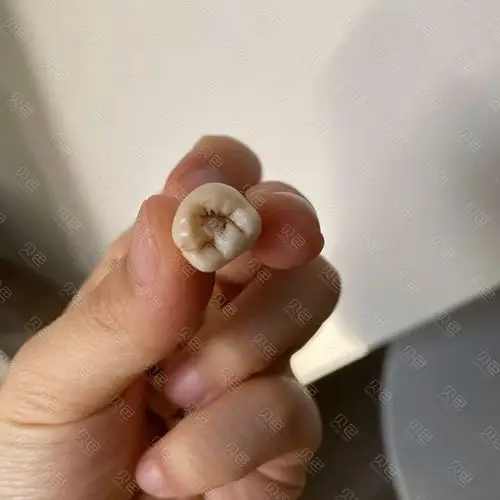 拔掉的牙齿
