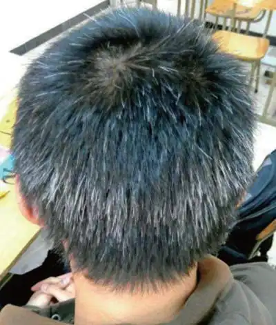 q:翔宇的少白发会是学习压力过大导致的吗?