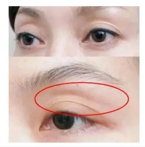 上眼睑严重凹陷可以填充吗用什么材料呢