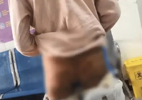 狠心10岁女童遭亲生母亲虐打警方介入