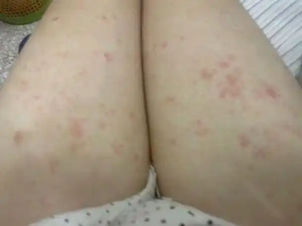 大腿皮肤一片一片的红的还发痒,也不知道是什么病!