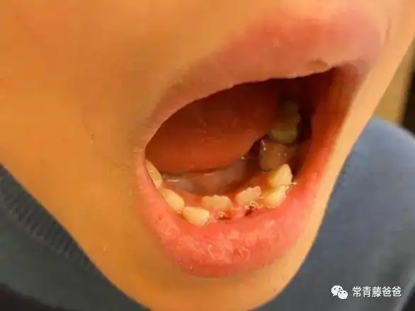 儿子长了"双排牙",爸爸悔不当初:5岁以后还这么干,只会害苦孩子!