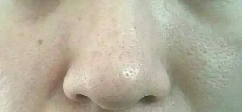 毛孔粗大是最让你头疼的皮肤问题吗教你几招缓解毛孔粗大