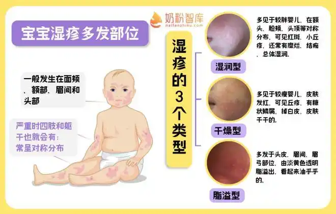 宝宝出疹子了是湿疹痱子还是其他皮疹教你辨别和处理