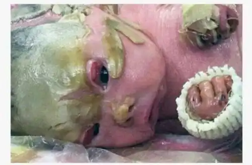 妈妈坚持留下鱼鳞症宝宝与病魔抗争竟奇迹康复