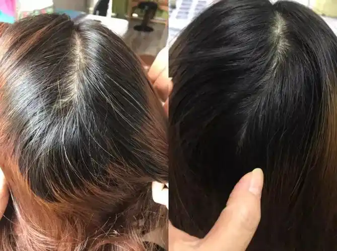 少年白头发是什么原因呢?面对这些白头发该怎么办呢?