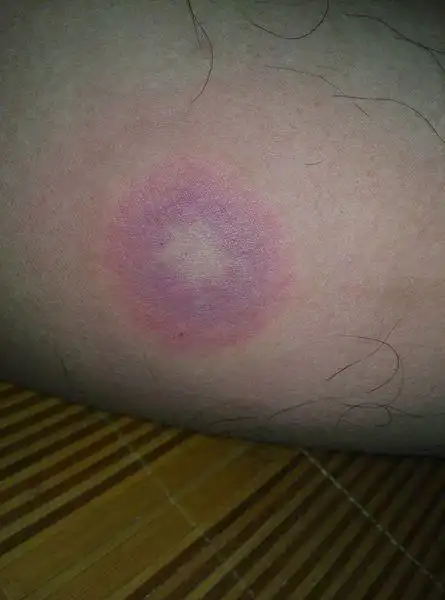 挥手阡陌| 分类:皮肤科 分享到:  2014-09-26 20:59 提问者采纳 疥疮