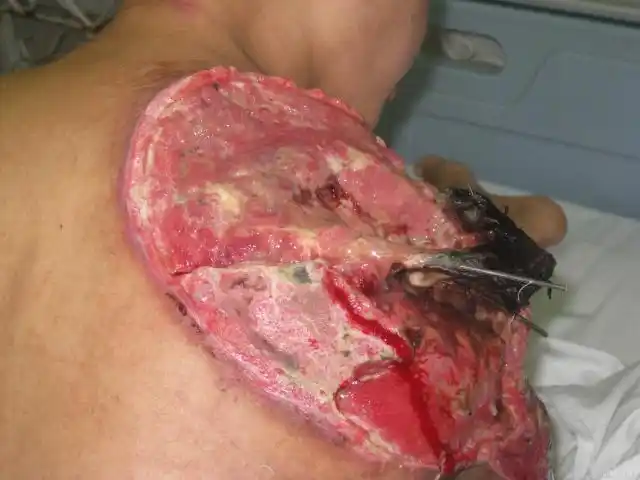 右膝后大面积皮肤软组织坏死治疗求助