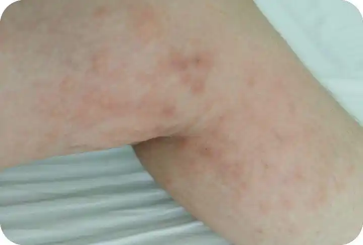 湿疹图片初期症状图片?看完图片才知道自己是否得了湿疹