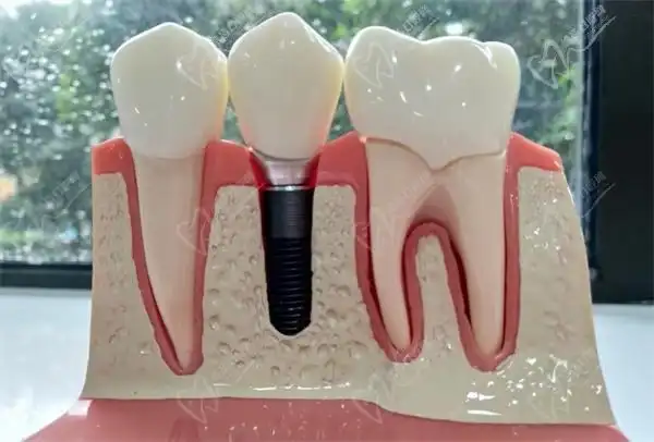 种植牙模型
