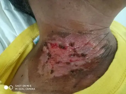 放射性溃疡中药外用愈合