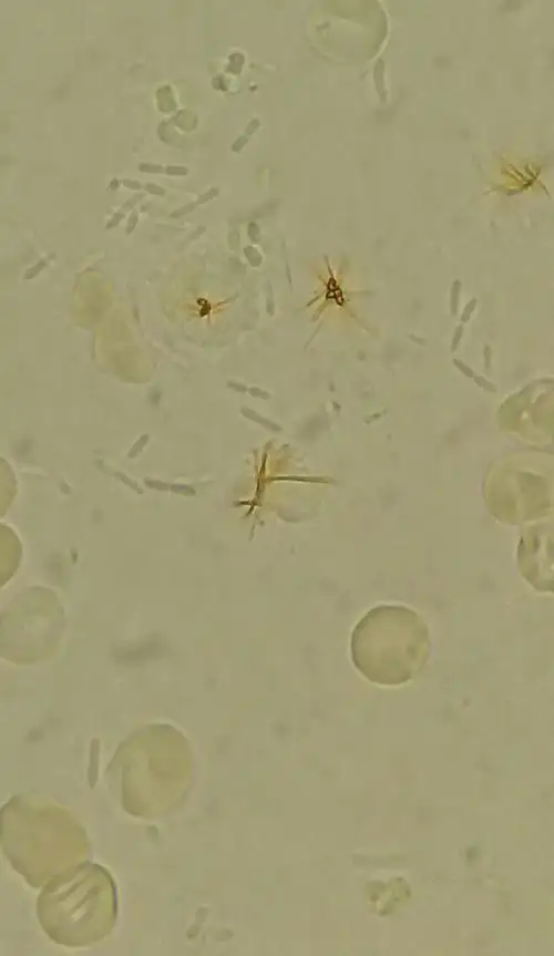 尿液中的胆红素晶体