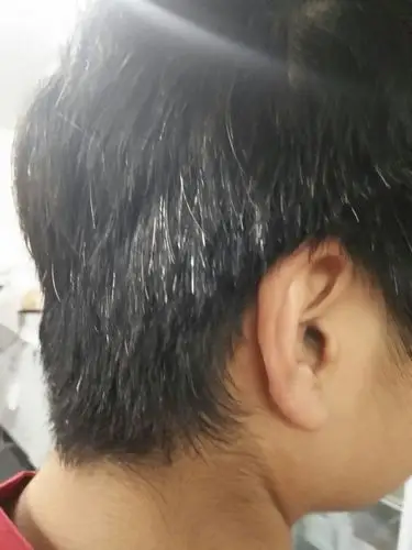 17岁,男,少白头,,已经有5年时间了了