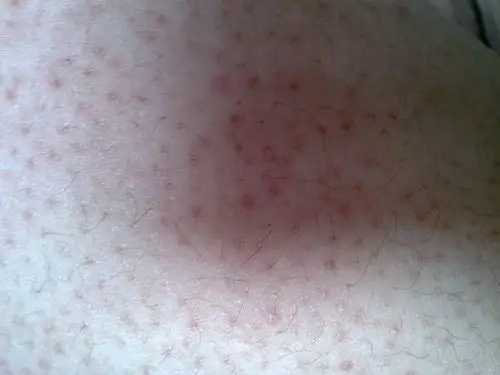 手臂皮肤病