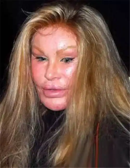 慎点!整容失败惊悚案例 美女一个个都整成怪物