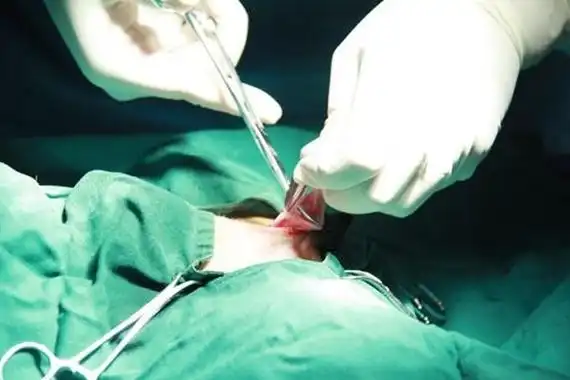 只针对女性来说,结扎在医学上又称之为输卵管结扎手术,通过手术方法