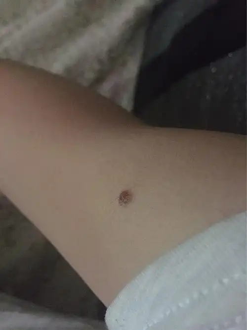 求大神科普关于右手臂有痣的问题!