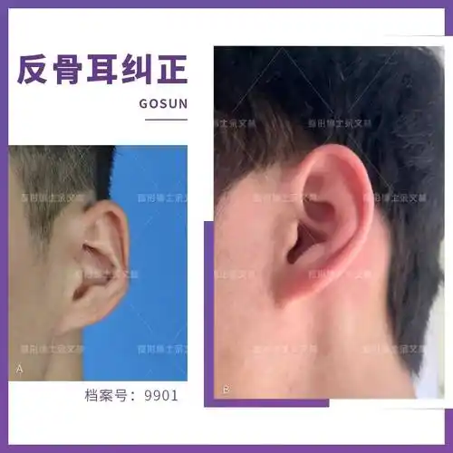 案例分析这个反骨耳患者耳骨外翻严重他觉得不好看做手术修复了