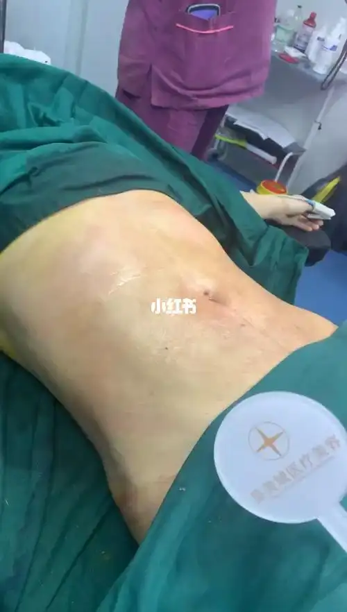 肚脐开口的腰腹环吸