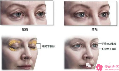 眼睑下垂矫正价格主要受到哪些因素的影响