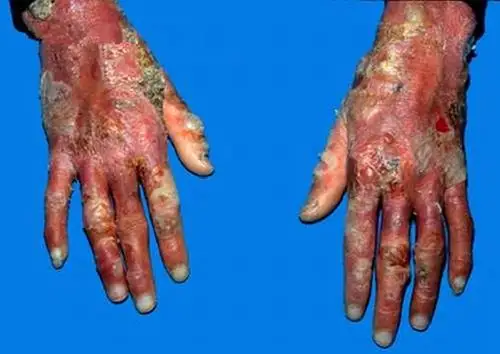 手严重大疱性皮肤病图片_有来医生