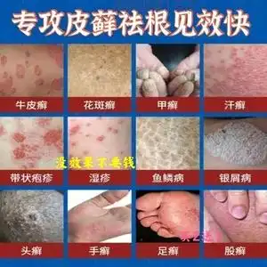 皮肤藓膏治牛皮藓手足廯体股癣去根黄皮肤瘙痒过敏湿疹止痒抑菌药
