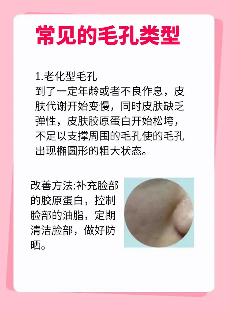 最后总结,毛孔粗大的原因 1.油脂分泌过旺  - 抖音